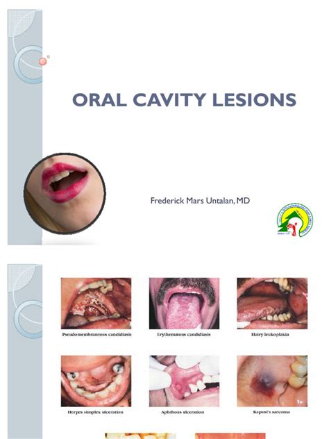 Oral Cavity Lesions Candidiasis Cutaneous Conditions