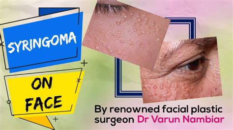 Treatment Of Syringoma By Facial Plastic Surgeon In Kerala Youtube