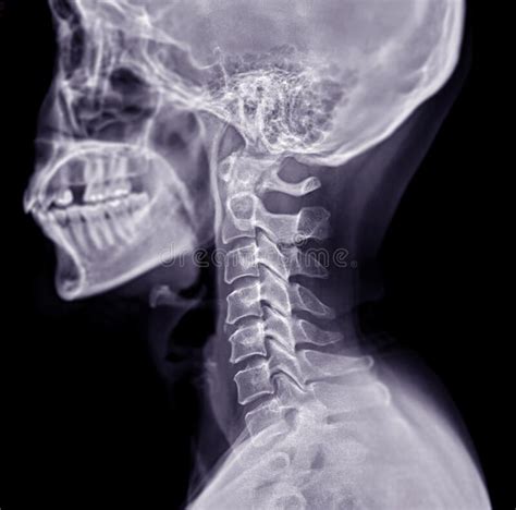 X Ray C Spine Or X Ray Image Of Cervical Spine Lateral View For