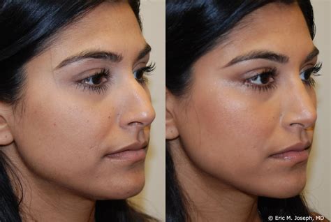 Eric M Joseph Md Rhinoplasty Before And After Nasal Profile