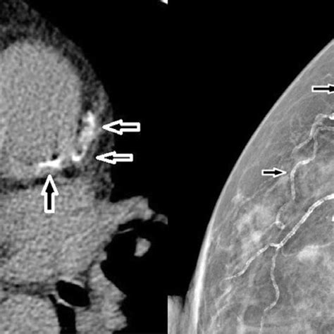 Mild Calcification In The Left Anterior Descending Coronary Artery Of A