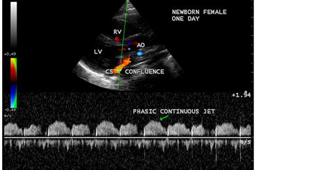 Rare case of an unroofed coronary sinus: Coronary Sinus Atrial Septal Defect (Unroofed Coronary ...