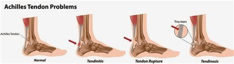 Myo Therapy Healthcare Institute Achilles Tendinopathy 65880 Hot Sex Picture