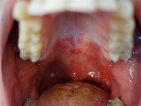 Assiette Sanctuaire Capillaires Red Spots Inside Mouth Objectif