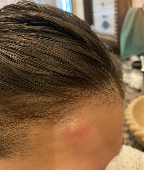 My Forehead Mosquito Bite Aka Skeeter Syndrome Reaction I Have A Total