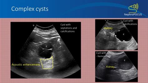 Renal Cyst Simple Or Complex Nephropocus