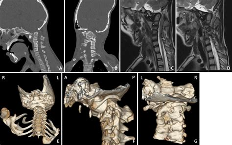 Surgical Management Of Atlantoaxial Dislocation And Cervical Spinal