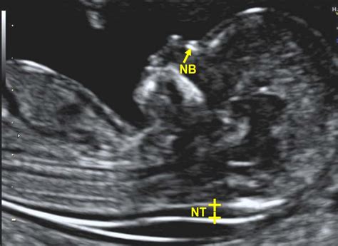 An ultrasound is performed at this stage of pregnancy to confirm your due date, confirm if you are having singles, twins or more and to visualise your baby's heart beating. Nuchal Translucency Scan (NT) | MNSonography