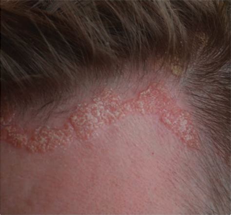 Scalp Psoriasis Punca Dan Cara Rawatan Jangka Pendek Faith Fleur