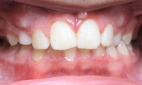 Transitional Dentition The Presence Of Primary Teeth And Permanent