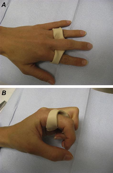 How The Wide Awake Approach Is Changing Hand Surgery And Hand Therapy