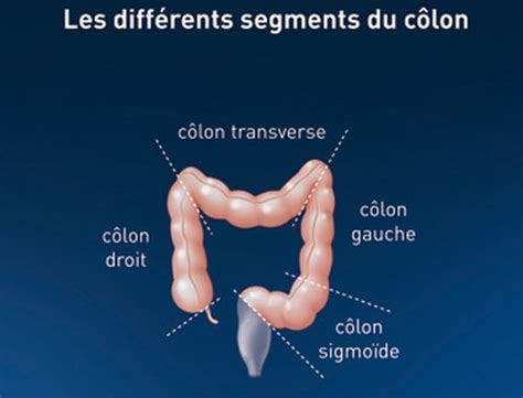 Cancer Colorectal La Survie Dépendrait De La Localisation De La Tumeur