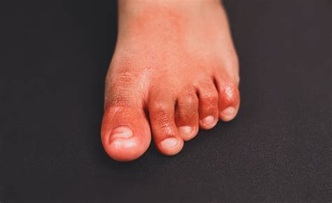 Rheumatoid Arthritis Feet