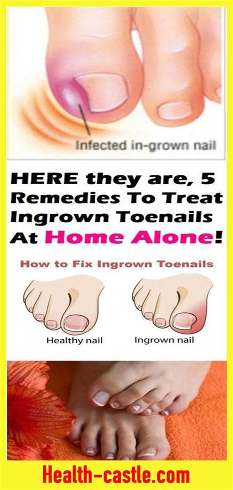 5 Remedies To Treat Ingrown Toenails At Home Ingrown Toe Nail Toe