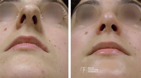 Rinoplastia Clínica Do Nariz E Face Especialistas Em Face