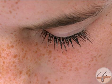 Facts About Freckles Know From A Dermatologist Dermacosm