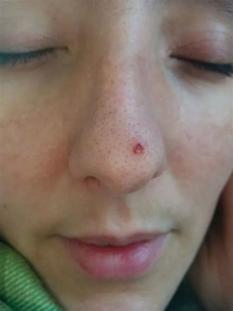 Tanning Addict Has Tip Of Nose Cut Off After Pimple Turned Out To Be