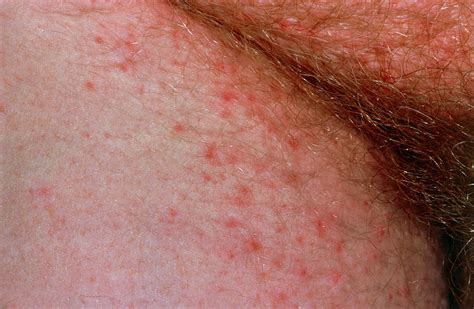 Scabies Infection Near The Groin Photograph By Dr P Marazziscience Photo Library