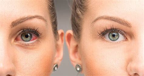 Sindrome Da Occhio Secco Studio Oculistico Dott Dav Specializzato