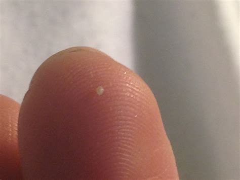 Little White Bumps On Skin Pictures Photos