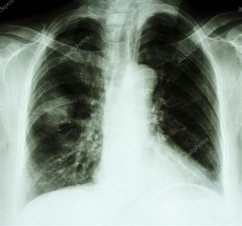 How are carcinoid tumors diagnosed? Raio-x no peito do paciente de câncer de pulmão — Fotografias de Stock © stockdevil_666 #61372651