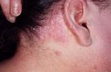 Pictures of Psoriasis On Your Scalp Treatment