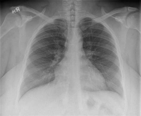 Normal Chest Pa And Lateral X Rays Case Studies Ctisus Ct Scanning