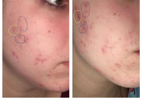 Does This Look Like Purging Pics General Acne Discussion