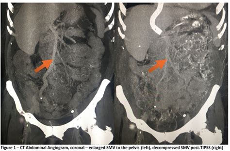 Portal Hypertensive Colopathy With Pelvic Varices Presenting As Severe