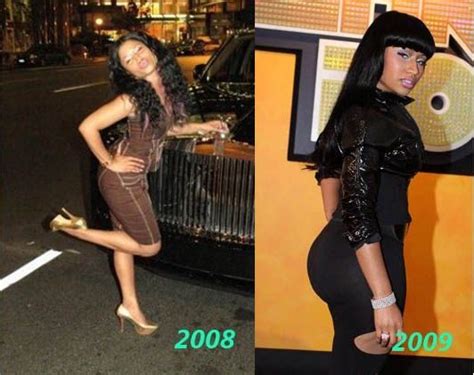 Nicki Minaj Buttocks Before And After Butt Implants Hair Implants Butt Implants Nicki Minaj