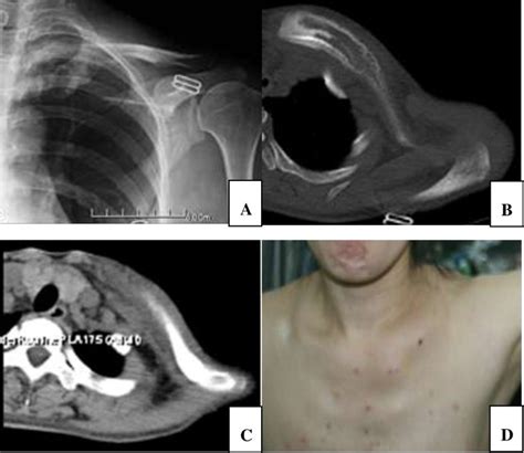 Outcome Of Bone Defect Reconstruction With Clavicle Bone Cement