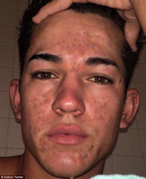 Teen Clears Cystic Acne By Hydrating And Getting Rid Of Stress Daily