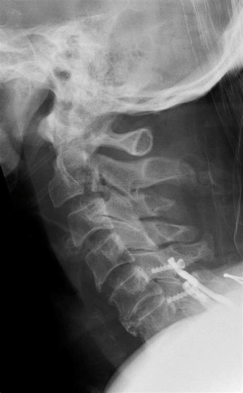 Hangman Fracture Radiology Case Medical