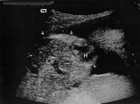 Ectopia Cordis Detected By Ultrasonography In The Axial Thoracal Plane