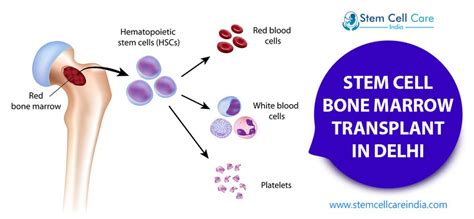 What Are The Types Of Bone Marrow Transplant Stem Cell Care India