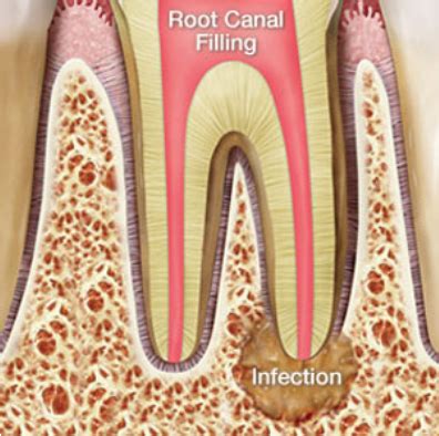 A root canal involves deep cleaning inside the canals (the inner chamber of the root) of your tooth, which can in turn. Reasons Not to Delay a Root Canal Treatment - Woo Wang Dental
