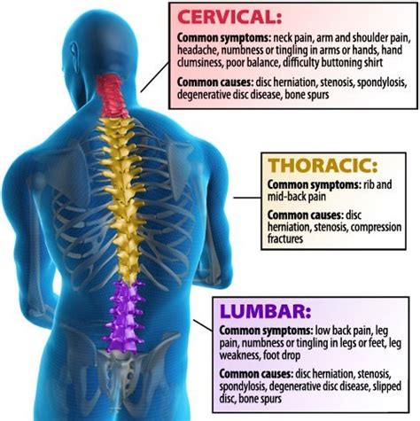 Similarly in computer networks a backbone network is as a network containing a high capacity connectivity infrastructure. Post-Laminectomy Syndrome | Arizona Pain Specialists ...