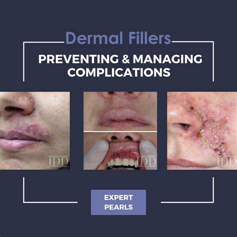 Dermal Filler Injections Preventing And Managing Complications Pearls