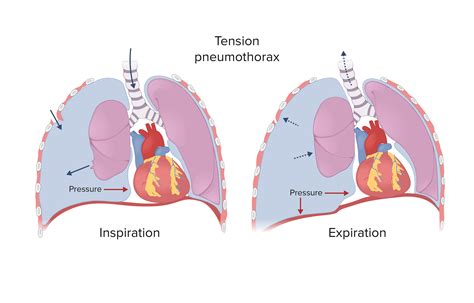 Tension Pneumothorax Diagram