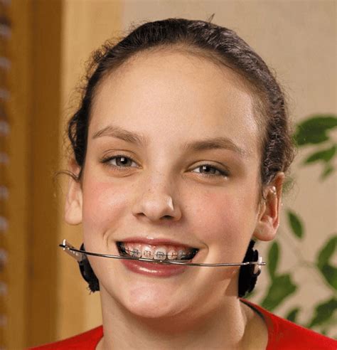 Headgear Is Used In Orthodontic Treatments Frenillos Dentales