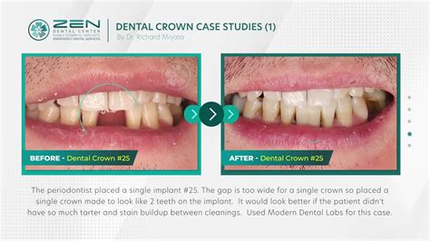 Zen Dental Dental Crown Case Studies 1 Dentist In Seattle
