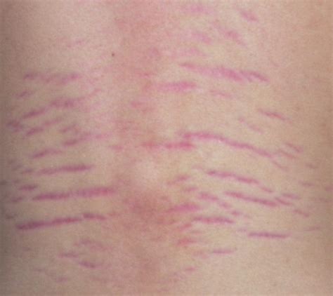 Stretch Marks Explained Causes Prevention And Treatments