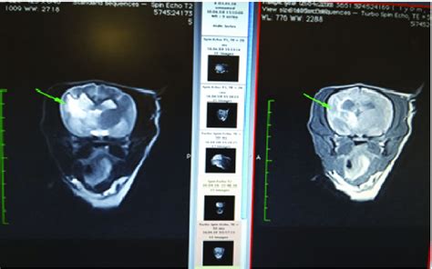 On A Series Of Mri Tomography In A T2 Weighted Image In The Left