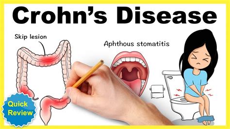 Crohn S Disease Symptoms Pathophysiology Diagnosis Treatment Mnemonic Quick Review Youtube