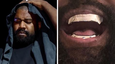 Kanye West Has Teeth Removed And Replaced With 850k Titanium Teeth