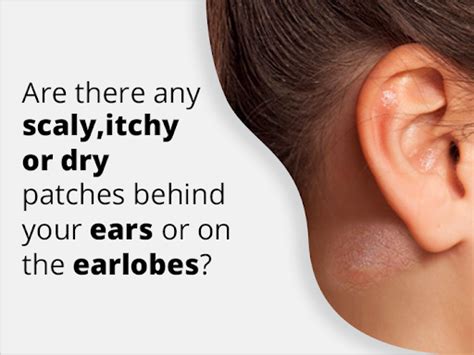 Eczema On Ear How To Get Rid Of Itchy Or Dry Ear Eczema