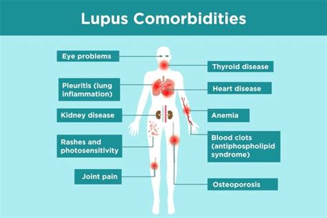 Lupus Komplikationer Hvad Lupus Patienter Skal Vide Balanced Body