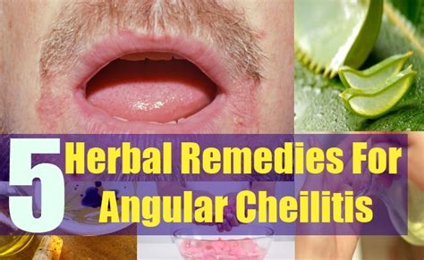 Effective 5 Herbal Remedies For Angular Cheilitis Natural Home