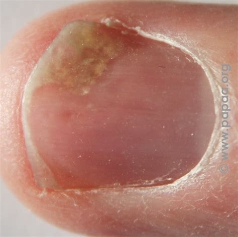 List 104 Pictures Psoriasis On Bottom Of Feet Pictures Latest