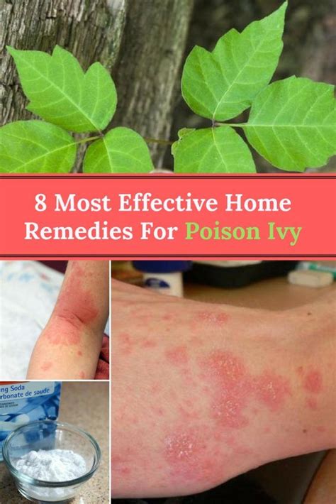 How To Treat Poison Ivy Fast
